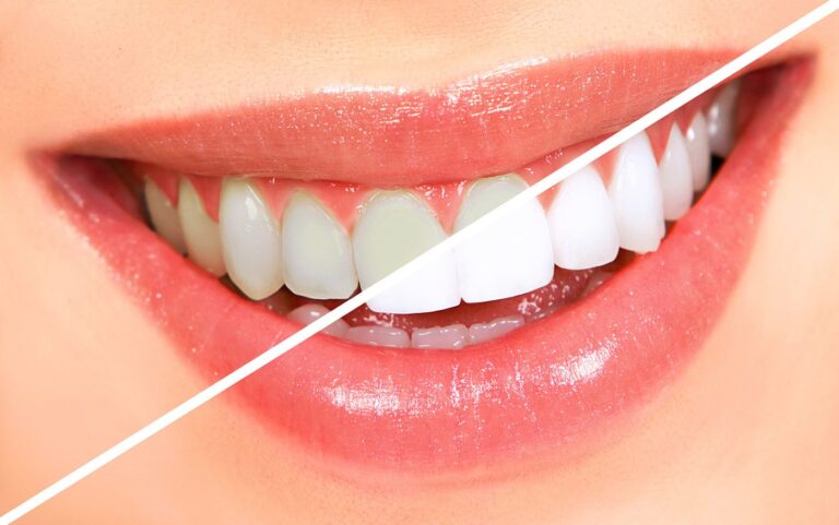 Brighten Your Smile with Professional Teeth Whitening at Rocky Ridge Family Dental