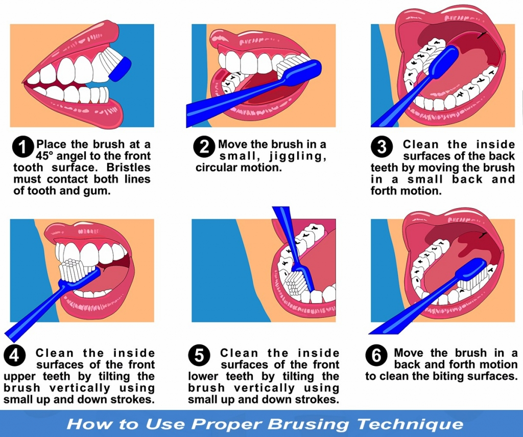 Illustration showing the steps for proper brushing technique:
1. Place the toothbrush at a 45° angle to the front tooth surface, ensuring the bristles contact both the tooth and gum line.
2. Move the brush in a small, jiggling, circular motion.
3. Clean the inside surfaces of the back teeth using a small back-and-forth motion.
4. Clean the inside surfaces of the front upper teeth by holding the brush vertically and using small up-and-down strokes.
5. Repeat the same vertical motion for the lower front teeth.
6. Move the brush in a back-and-forth motion to clean the biting surfaces of the teeth.
The image includes the title: “How to Use Proper Brushing Technique.”